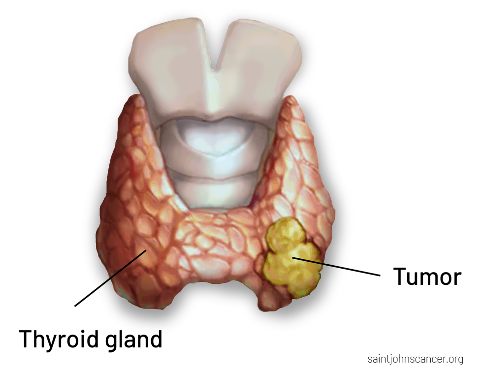 Larynx Cancer Image